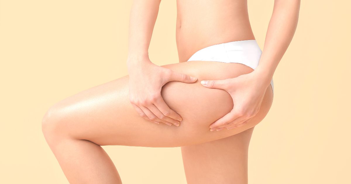 Combattere la ritenzione idrica nel modo giusto